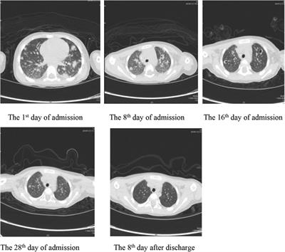 Necrotizing pneumonia and purulent meningitis caused by bloodstream infection of CA-MRSA in a child: A rare case report